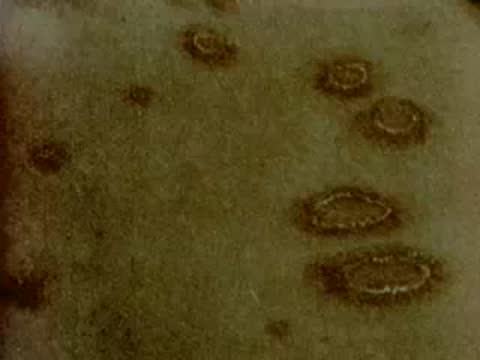 Close-up of human skin showing small circular lesions or spots being treated.