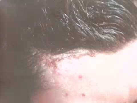 Close-up of a person's scalp and hair with visible skin conditions.