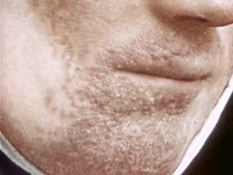 Close-up of a person's face showing skin blemishes and texture around the mouth.