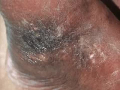 Close-up of a dark, scaly skin condition on a patient's body part.