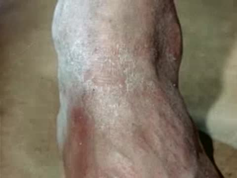 Close-up of scaly skin showing improvement or treatment progress.