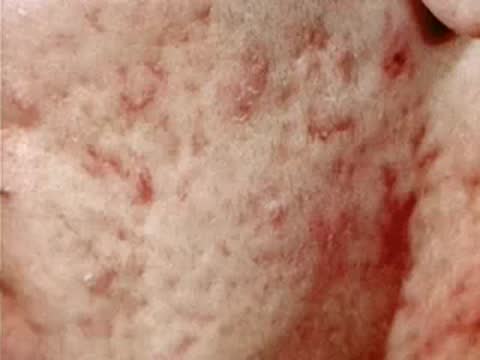 Close-up of skin lesions being treated with a specialized medical device.