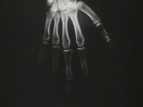 X-ray image showing bones of a human hand on a dark background.
