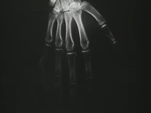 X-ray views of hand bones, followed by a fractured forearm bone.