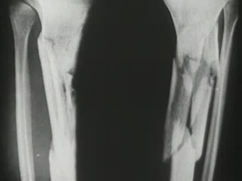 X-ray footage showing a severe bone fracture healing over time.
