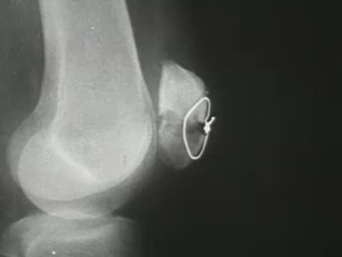 X-ray showing a human knee joint and patella with surgical wiring.