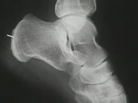 X-ray view of a human ankle and heel with a small pin inserted.