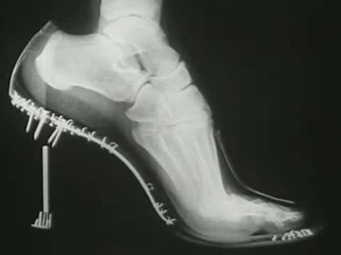 X-ray of a foot inside a high-heel shoe with surgical hardware and pins.
