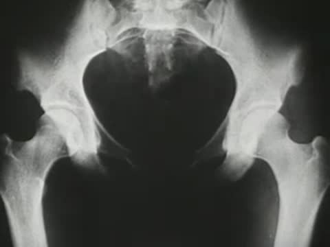 X-ray showing the human pelvis and hip joints from various angles.